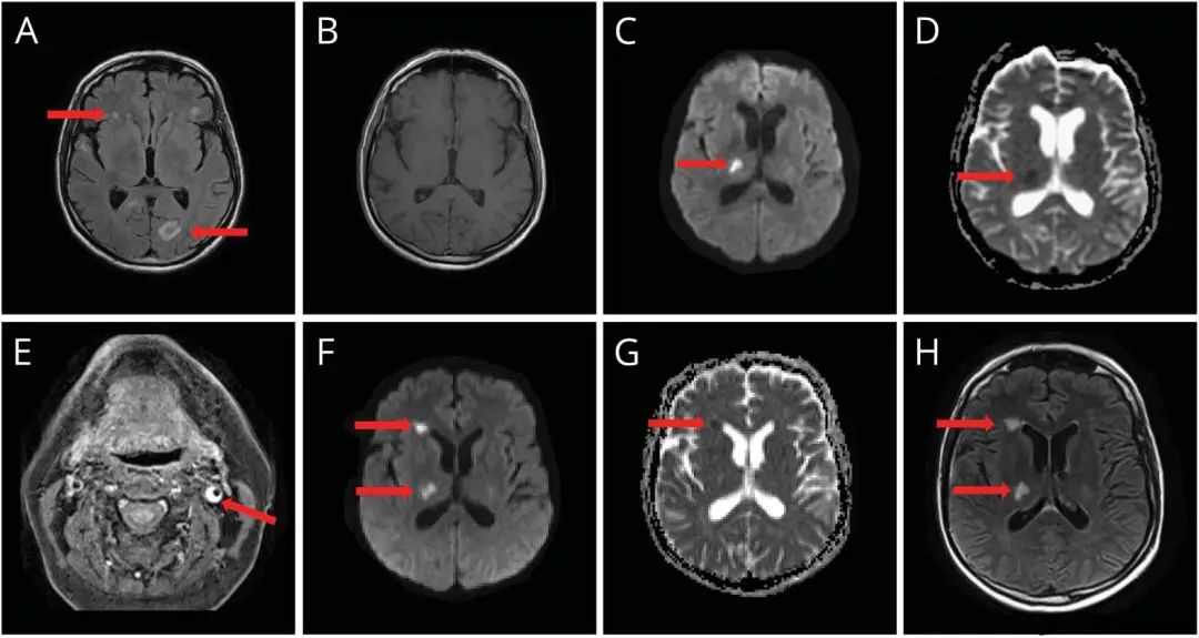 水痘带状疱疹病毒导致的颈动脉夹层，你遇见过吗？丨病例探究