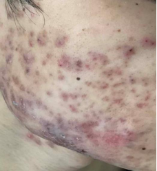 皮肤病医院 去除青春痘_痤疮专病门诊_广州市天河区中医医院皮肤科