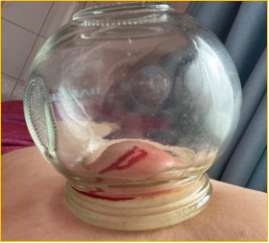 广州市天河区中医医院皮肤科_痤疮专病门诊_皮肤病医院 去除青春痘