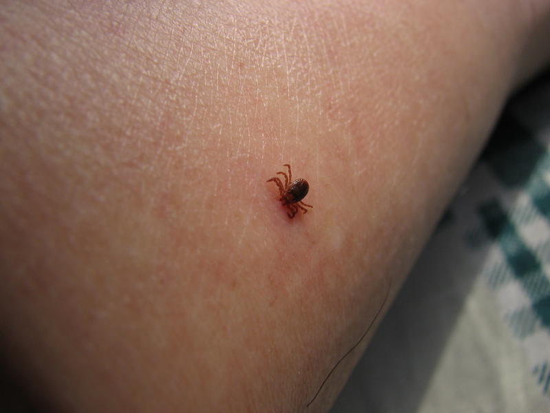 pg下载赏金下载 5岁男孩被蜱虫咬伤，爸爸的果断处理被医生称赞，值得家长学习