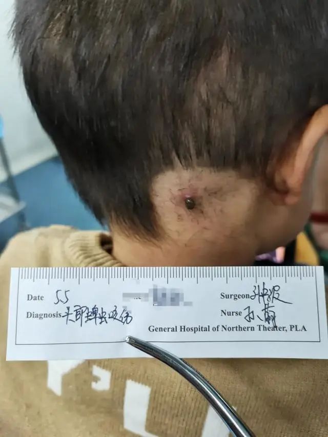 蜱虫叮咬症状_脾虫咬后的伤口图_蜱虫咬人案例