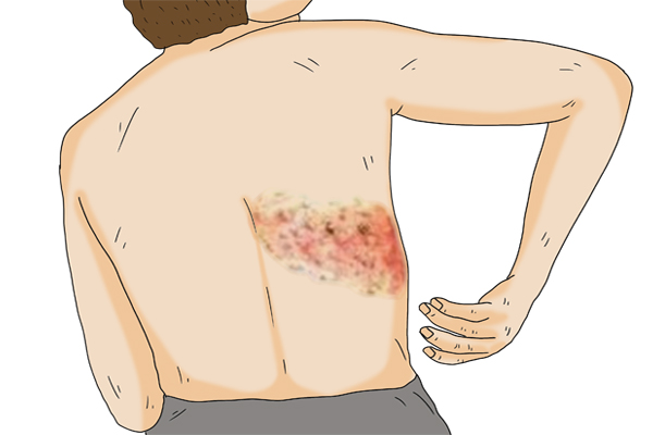 “缠腰龙”令人疼痛难忍，竟是癌症前兆，是真相还是谣言？