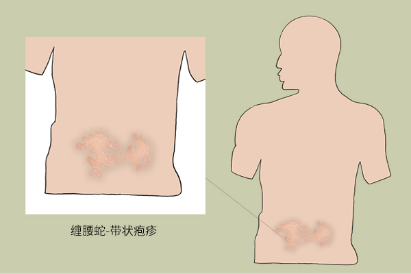 水痘病毒 带状疱疹·_病毒带状疱疹水痘几天能好_带状疱疹病毒性水痘怎么引起的