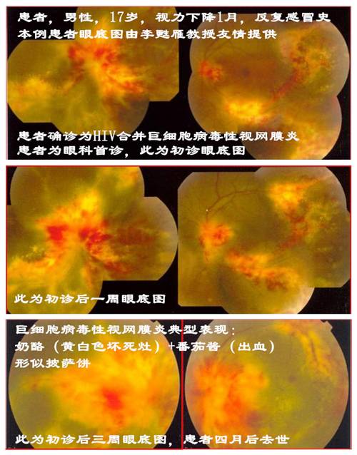 眼囊虫病早期症状_眼囊虫图片_眼囊虫图